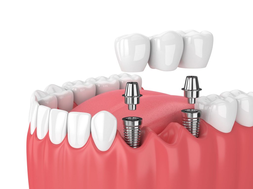 Dental implant technology philadelphia