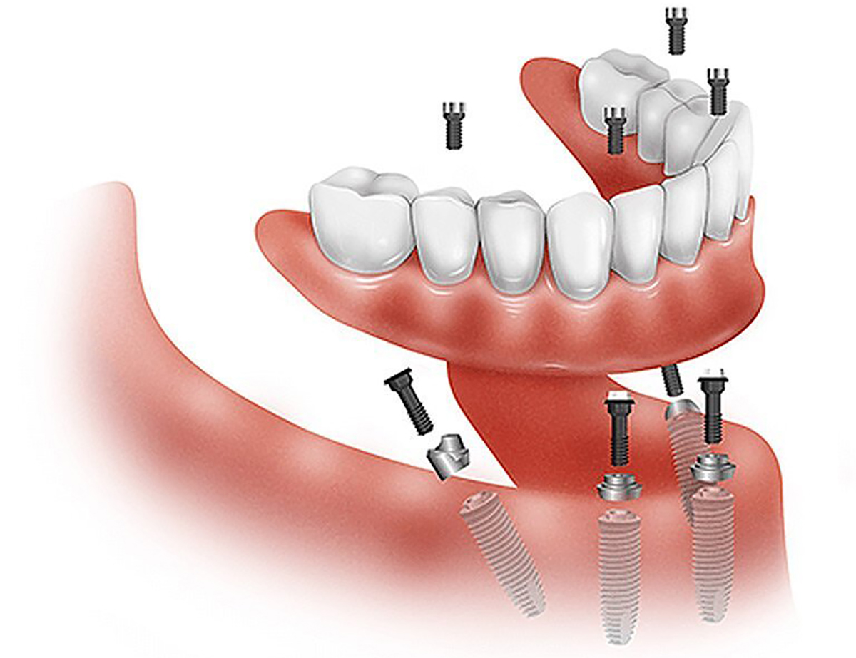 Dental implant technology philadelphia