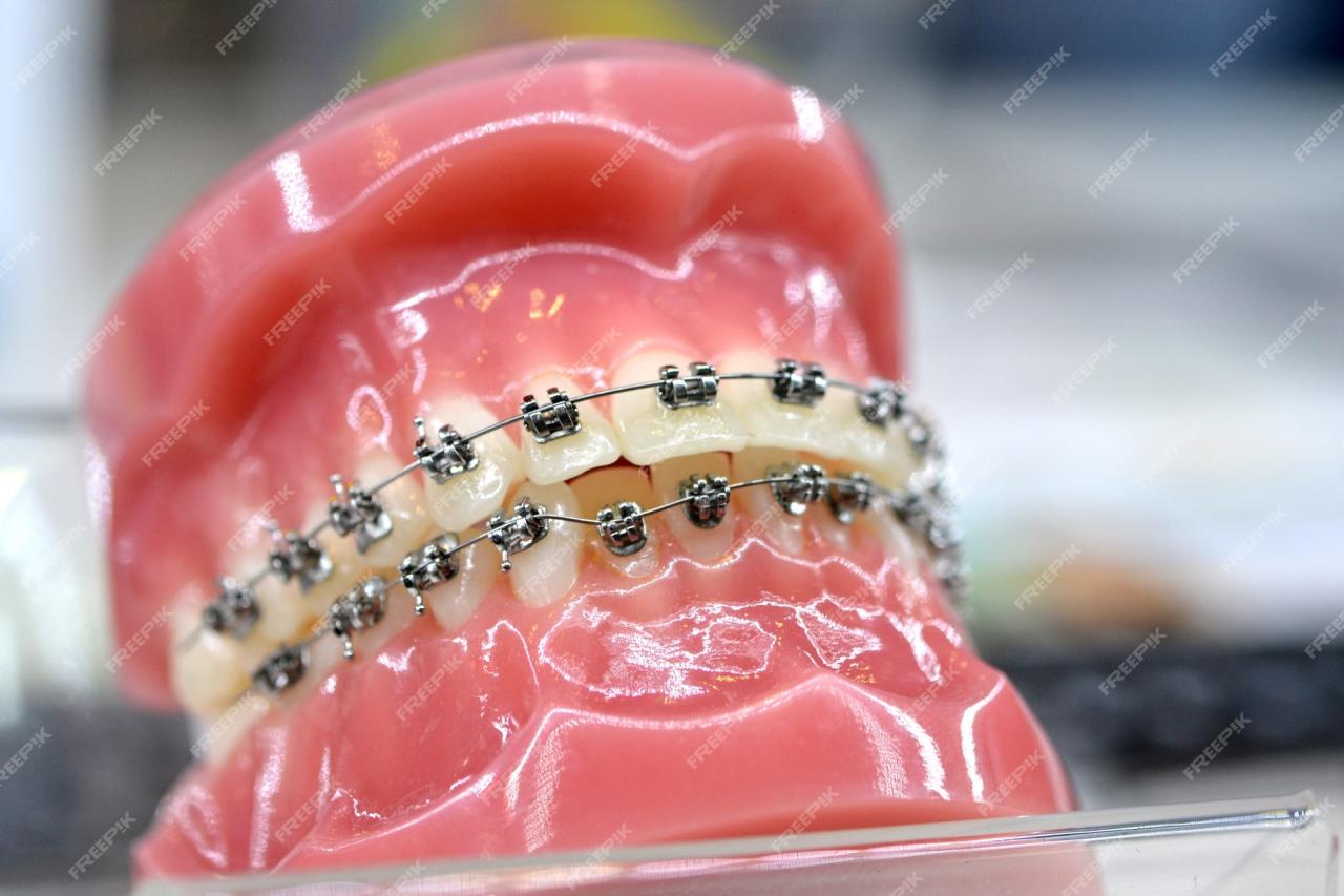 New teeth braces technology