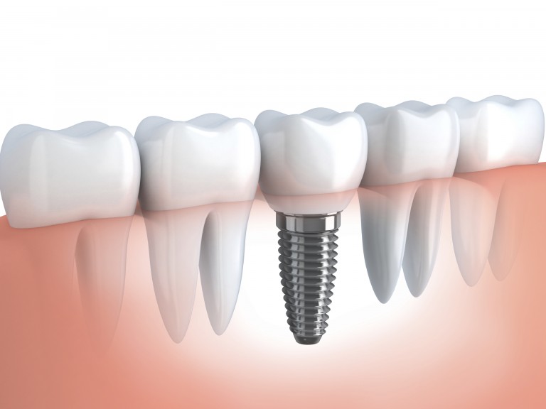 Dental implant technology philadelphia