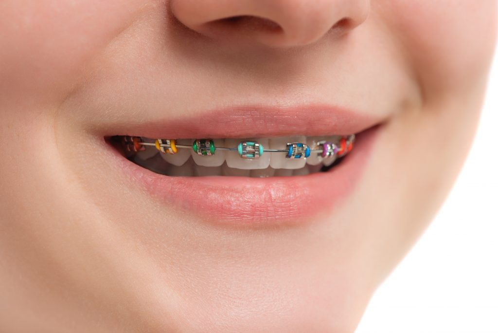 New teeth braces technology