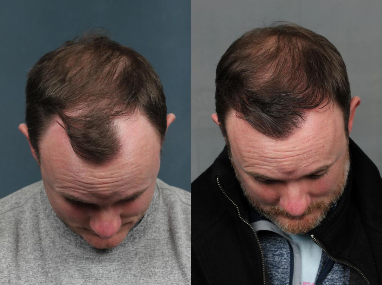 New hair transplant technology 2024