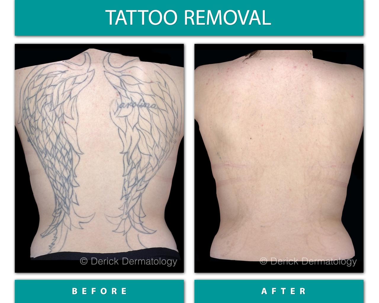 Tattoo laser removal pico after before session technology amazing save just our