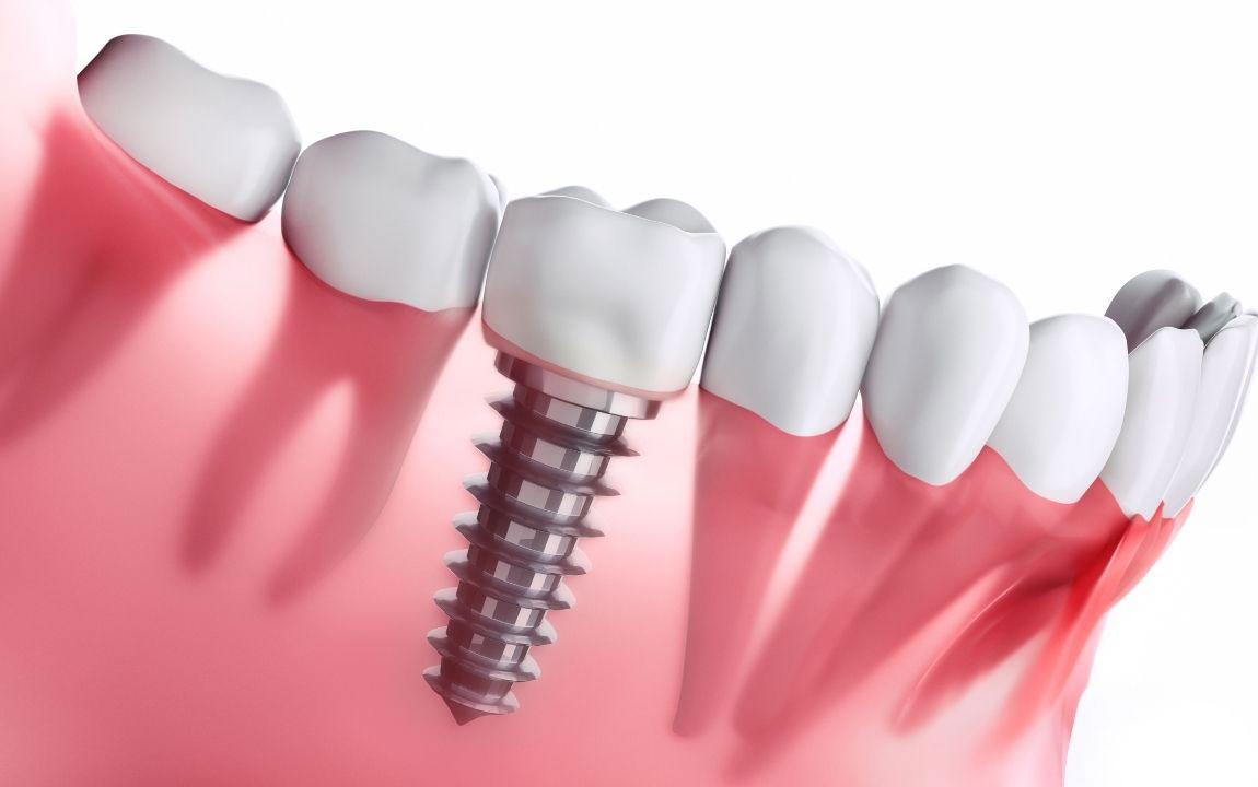 Newest dental implant technology